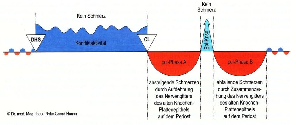 163 System des Schmerzverlaufs der Knochen, 8 Wochen kommt der Schmerz, von der Conflictolyse an, wird immer staerker – und 8 Wochen geht er und wird immer schwaecher
